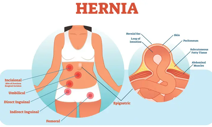 Hernia-12